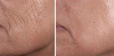 Results of Hyaluronic acid before and after Results of injectable anti-wrinkle treatment