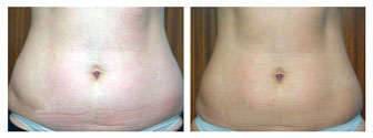 Aqualix before after