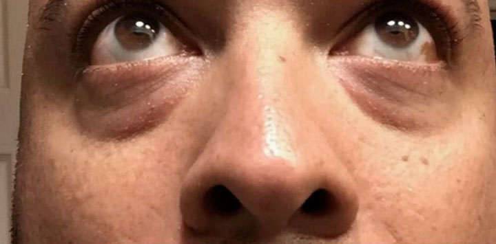 Under-eye bags