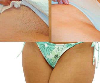 Hair Removal of the Pubic Area and bikini hair removal