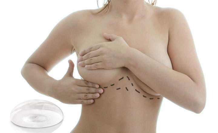 Breast Augmentation