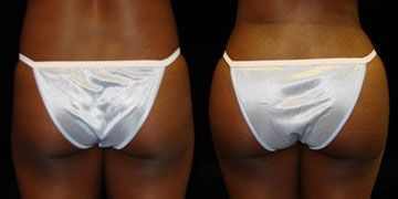 Buttock enhancement before and after