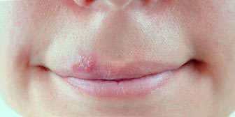 lysine Lysine: Properties, Uses, and Side Effects How to cure herpes with lysine