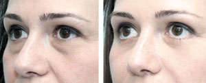 Dark circles and bags remedy