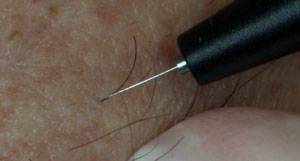 Permanent and forever electric hair removal Process of electrolysis hair removal