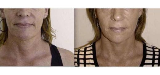 Facial rejuvenation treatments “With” and “Without” surgery