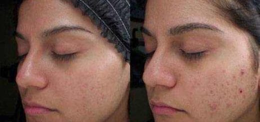 Homemade chemical peel with glycolic acid Homemade chemical peel with glycolic acid