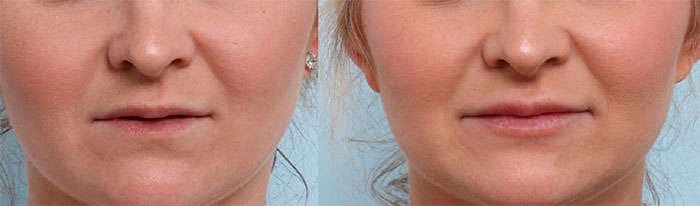 Results of Hyaluronic acid before and after Effects of hyaluronic acid before and after