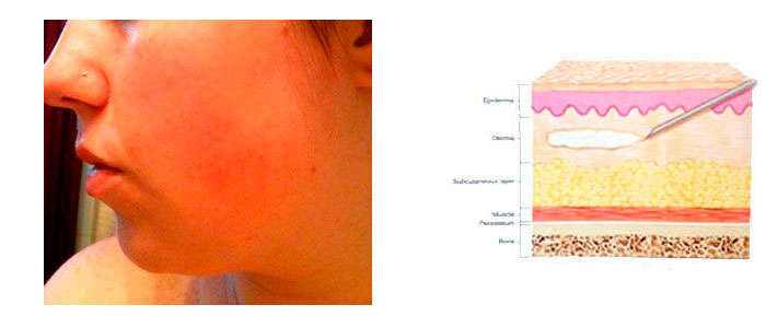 What Hyaluronic Acid Is and What It Is Used For in Aesthetics and Medicine Hyaluronic Acid: side effects and contraindications