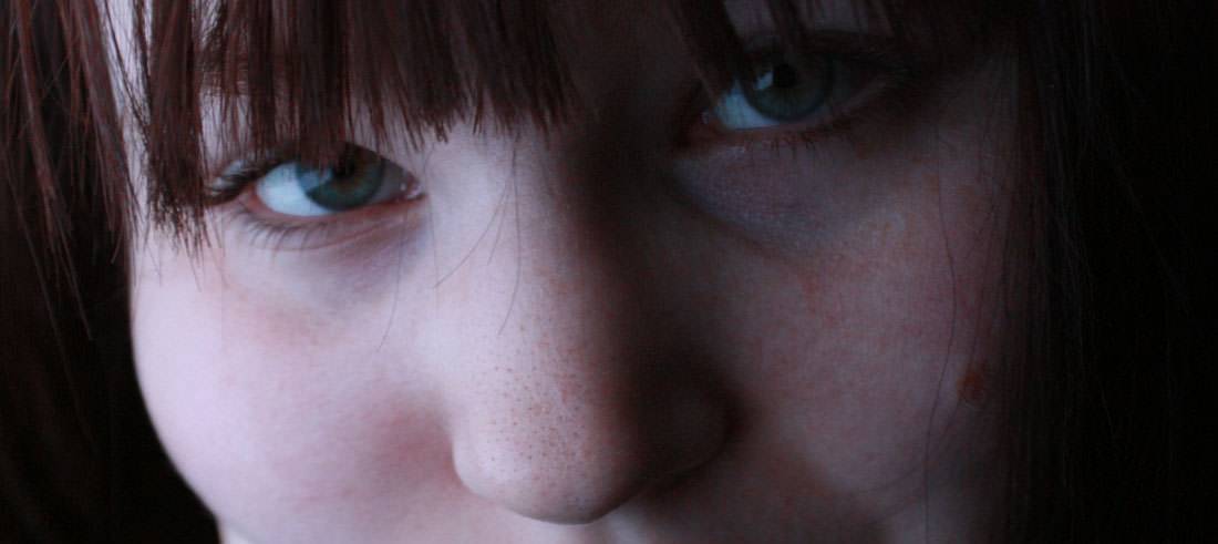 What Hyaluronic Acid Is and What It Is Used For in Aesthetics and Medicine How to remove dark circles with hyaluronic acid