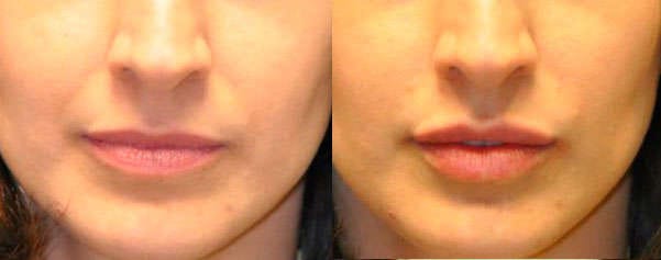 Results of Hyaluronic acid before and after Results of hyaluronic acid on lips