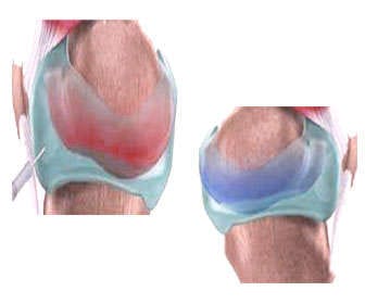 Results of Hyaluronic acid before and after Results of intra-articular hyaluronic acid