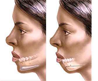 Mentoplasty with and without surgery, price, and results (before and after) Intraoral mentoplasty