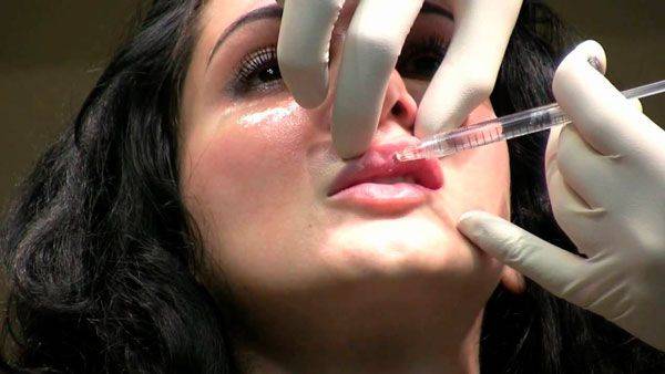 Lip filler with Juvederm