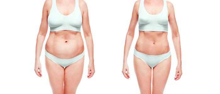 Liposuction before and after