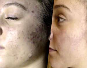 Mandelic acid: Do you know what it’s used for? Its uses as a peeling agent and depigmenter for healthy and youthful skin Mandelic acid peeling