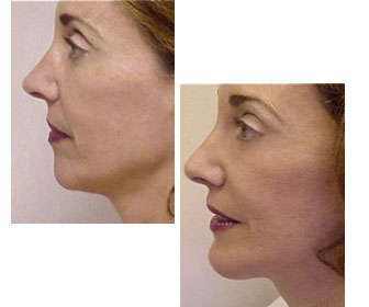 Mentoplasty with and without surgery, price, and results (before and after) Mentoplasty before and after