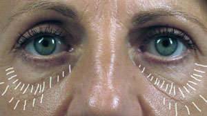 Mesotherapy under-eye bags