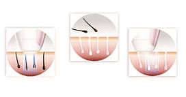 Philips Lumea Prestige, Advanced, and Essential Hair Removal Devices, BRI and SC prices How Philips Lumea Works