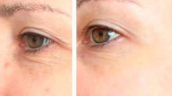 Results of Hyaluronic acid before and after Results of removing wrinkles around the eyes with hyaluronic acid