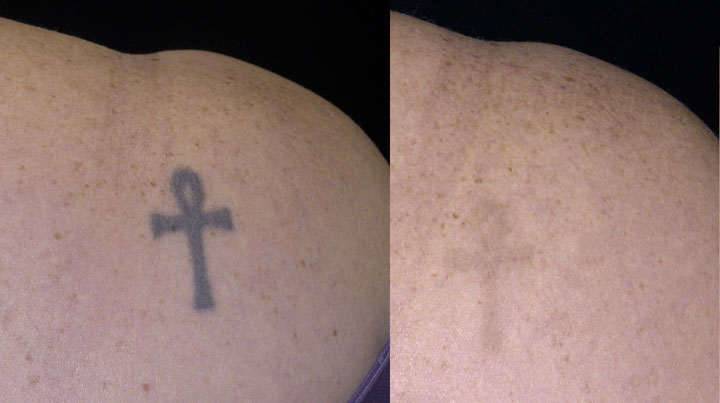 Tattoo removal