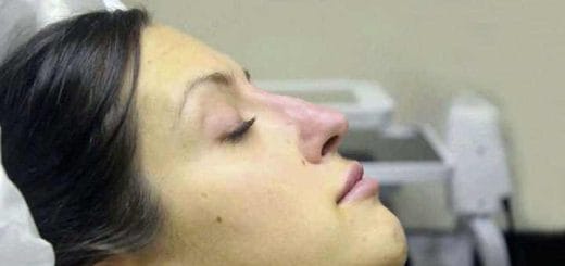 Rhinomodeling, non-surgical rhinoplasty Rhinomodeling, non-surgical rhinoplasty