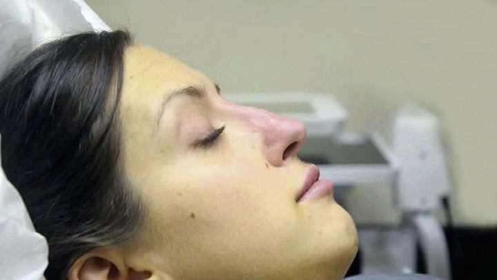 Rhinomodeling, non-surgical rhinoplasty Rhinomodeling, non-surgical rhinoplasty