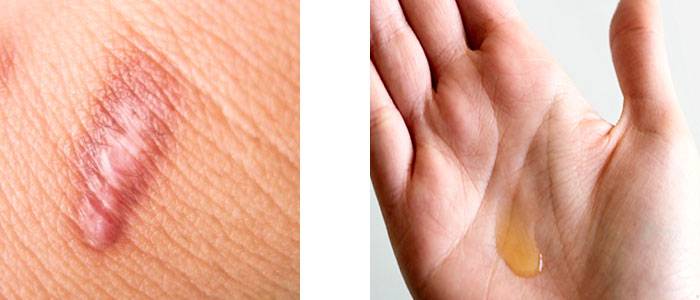 Use of rosehip oil for surgical scars