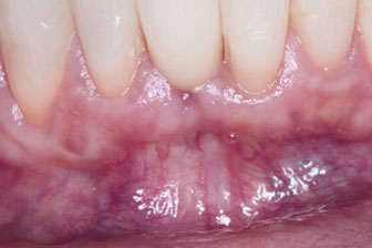 Ascorbic acid: What it is for, properties, foods, and side effects Scurvy and lack of collagen