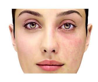 Tretinoin topical cream: uses for acne, skin spots, wrinkles, and stretch marks. Don't miss the recommendations. Skin spots before and after tretinoin treatment
