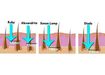 Differences Between Diode Soprano Laser and Other Hair Removal Lasers