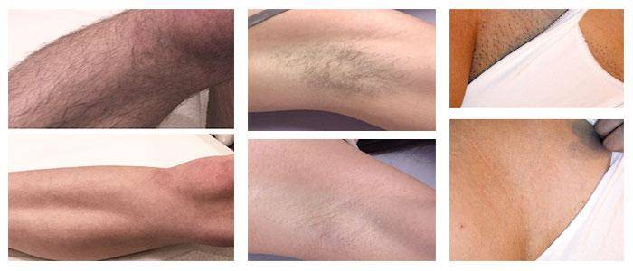 Soprano Laser Hair Removal Before and After