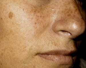 Sunspots on the face