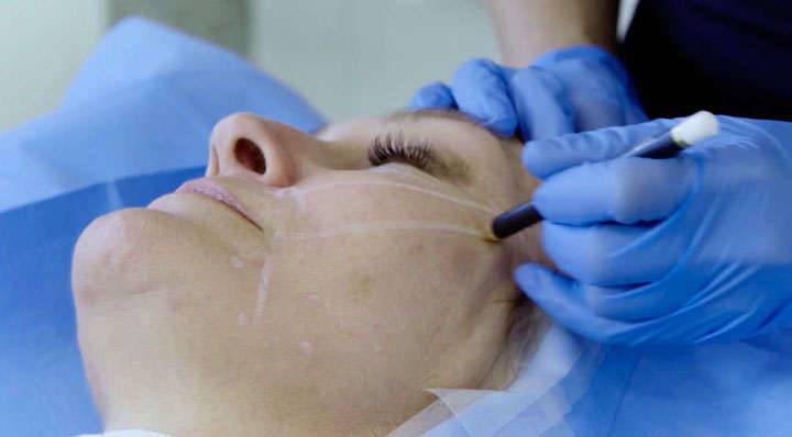 Thread Lifts or Magic Threads: Advantages, Duration, and Reviews Thread Lifts or Magic Threads: Advantages, Duration, and Reviews