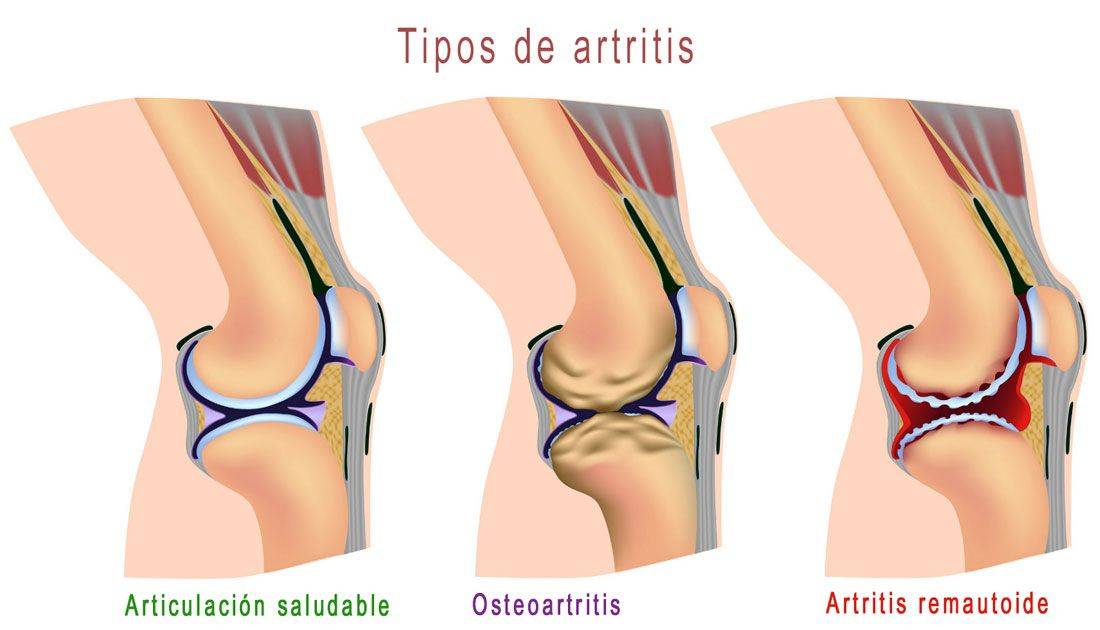 Knee Arthritis Treatment with Hyaluronic Acid Knee Arthritis Treatment with Hyaluronic Acid
