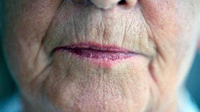 Upper lip and around the mouth wrinkle Upper lip and around the mouth wrinkle