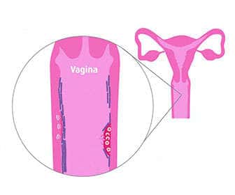 Vaginal probiotics
