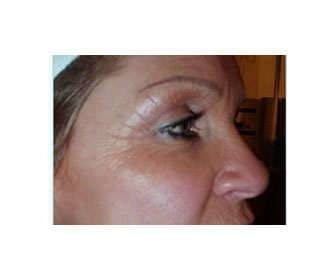 Tretinoin topical cream: uses for acne, skin spots, wrinkles, and stretch marks. Don't miss the recommendations. How to remove wrinkles on the face with tretinoin