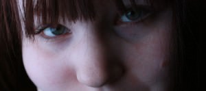 Cómo eliminar las ojeras con Ácido hialurónico