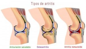 Tipos de artritis