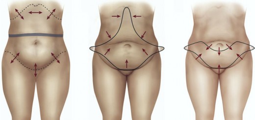 abdominoplastia