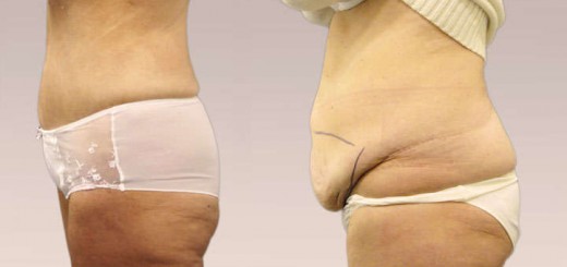 precio de abdominoplastia
