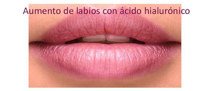 Aumento de labios con ácido hialurónico (Relleno, inyección)