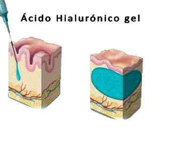 acido hialuronico para relleno facial