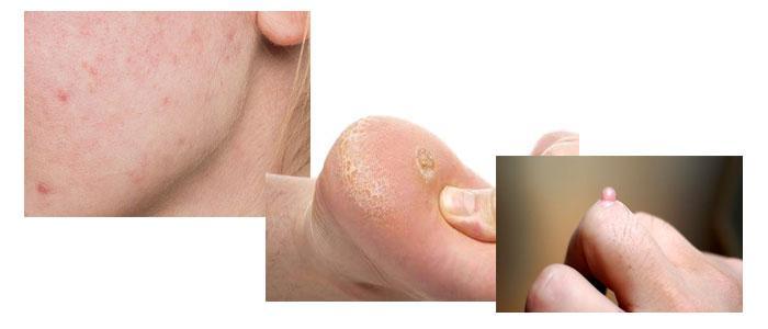 Usos del ácido salicílico para el acné, verrugas y callos
