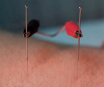acupuntura electronica agujas
