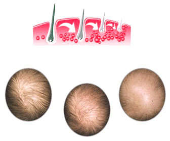 alopecia androgenica causas