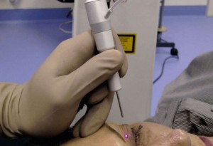 blefaroplastia laser