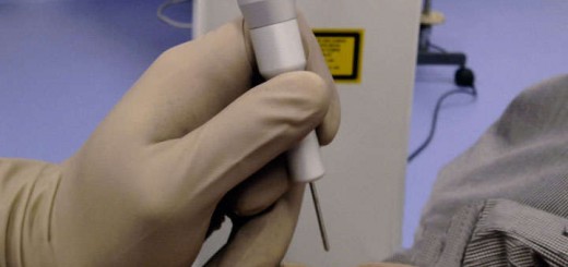 blefaroplastia laser