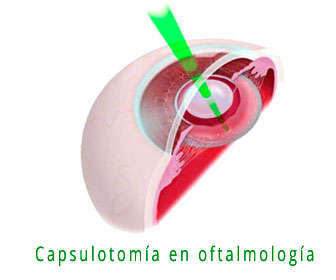 capsulotomia con yag laser